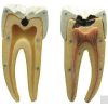 Dental Caries Model