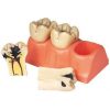 Dissected Model Of Dental Caries